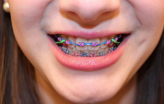 Is it really that bad to eat with rubber bands on your braces